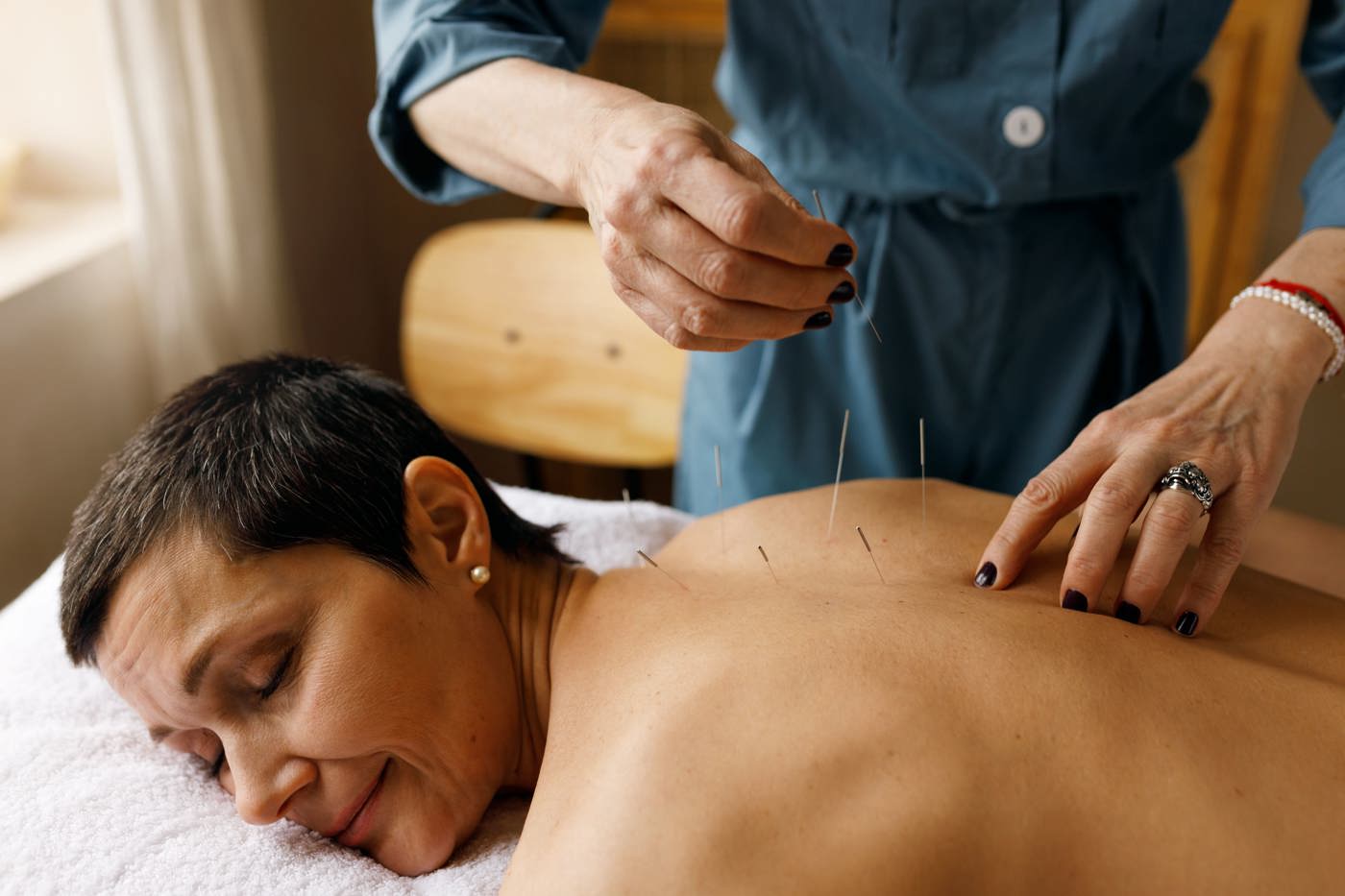 Frau wird mit einer Akupunktur am Rücken behandelt.